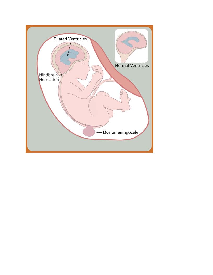 Spina Bifida photo