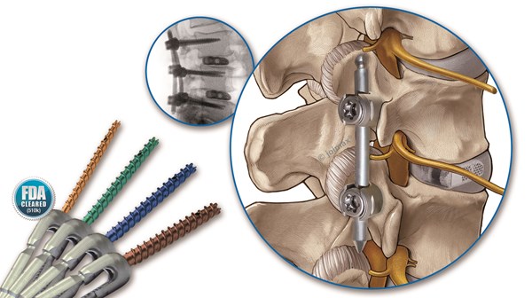 joimax Percusys Pedicle Screw Rod System
